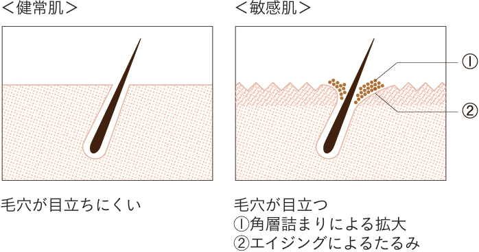 敏感肌特有の拡大毛穴とは？