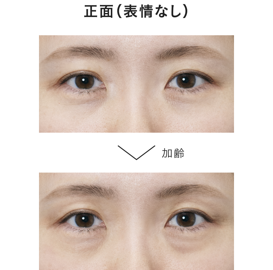 加齢により、シワや影・上まぶた・下まぶたのハリ不足などの悩みが重なります。
