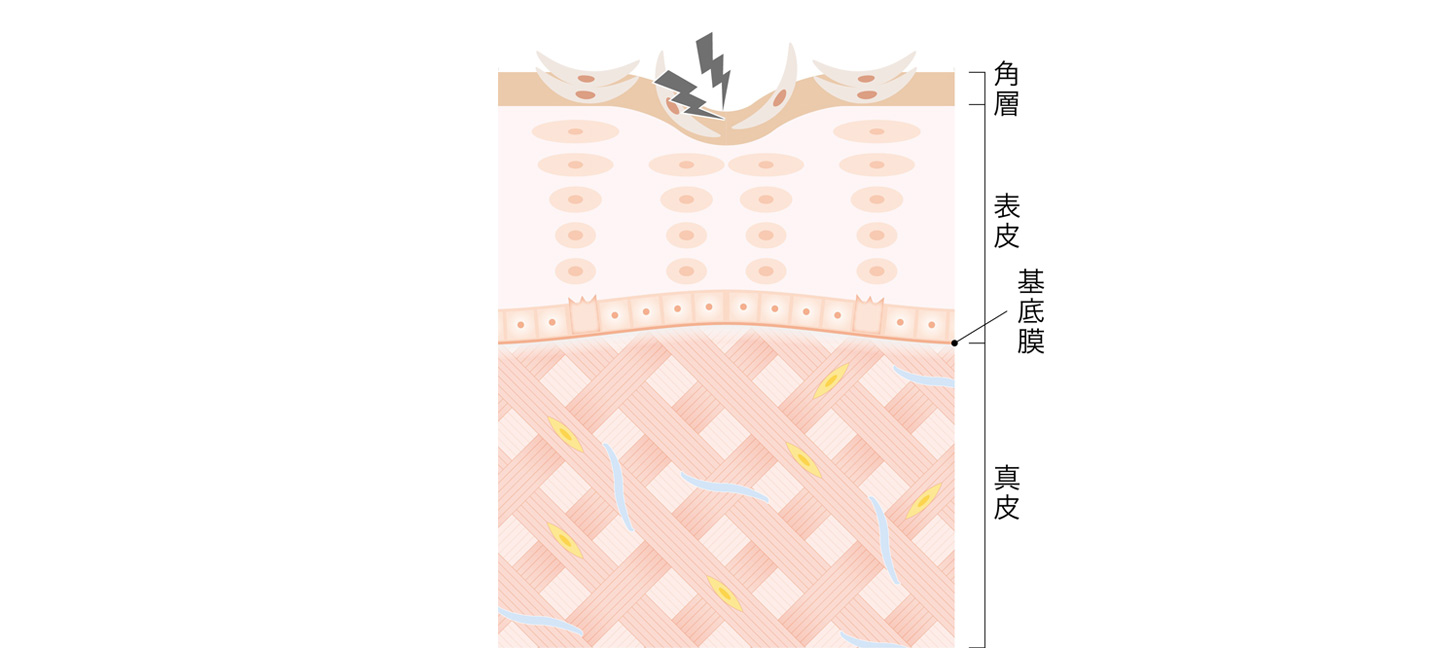 角層が折れる