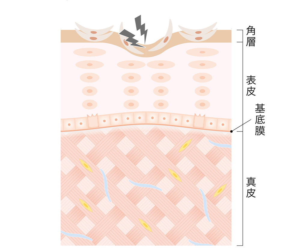 角層が折れる